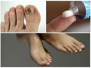 nail fungus foot balm
