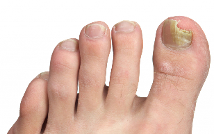foot nail fungus stage
