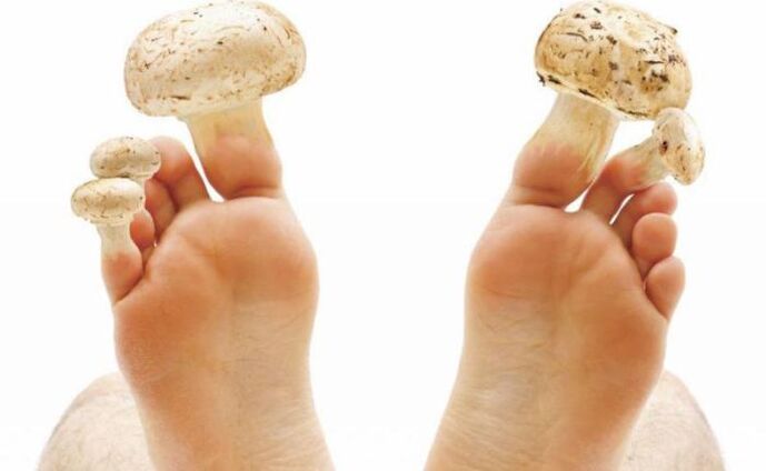 causes, symptoms and treatment of fungus on the feet