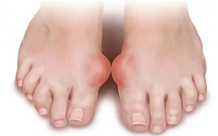 deformation of the foot as a cause of fungus on the feet