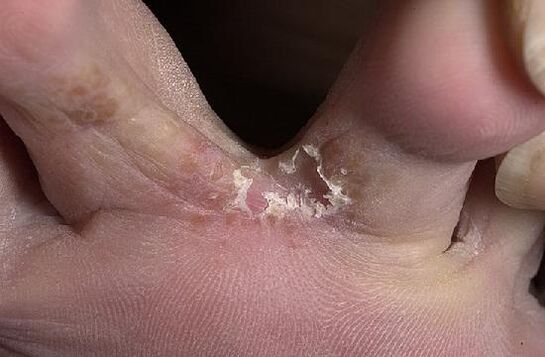 fingers affected by the fungus