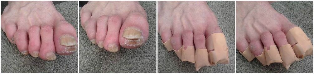 Applying fungus patches on toenails