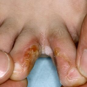 Signs of fungus between the toes