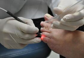 Laser treatment of nail fungus