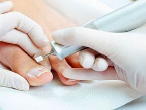 Therapeutic pedicure for nail fungus