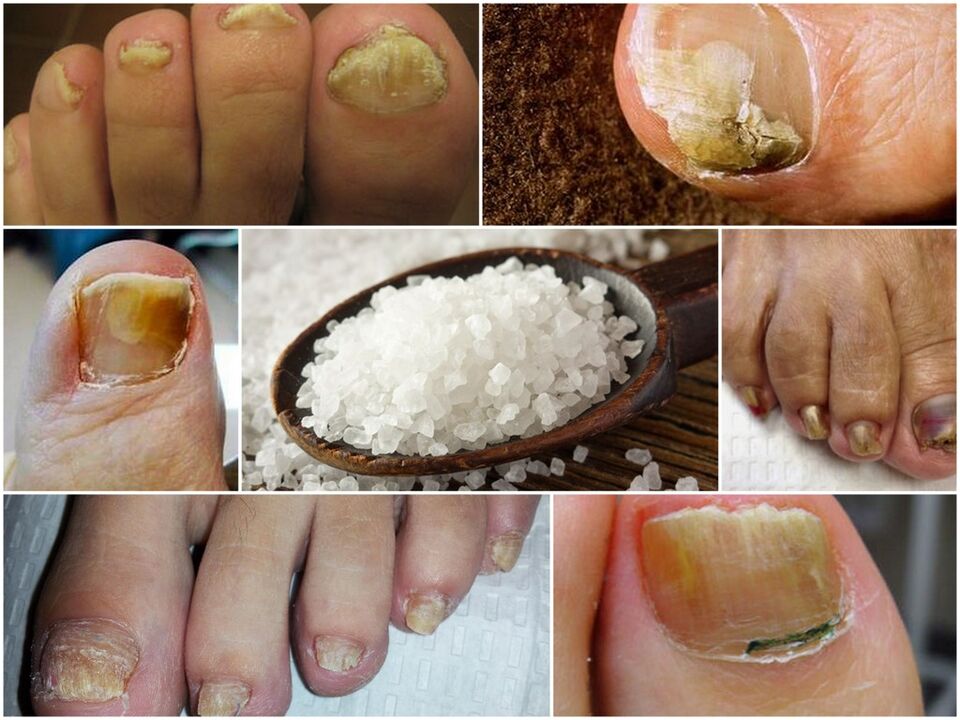 The fight against the fungus