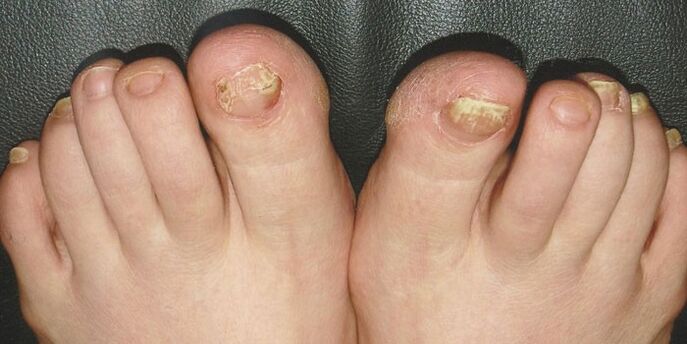 Onychomycosis of the toenails