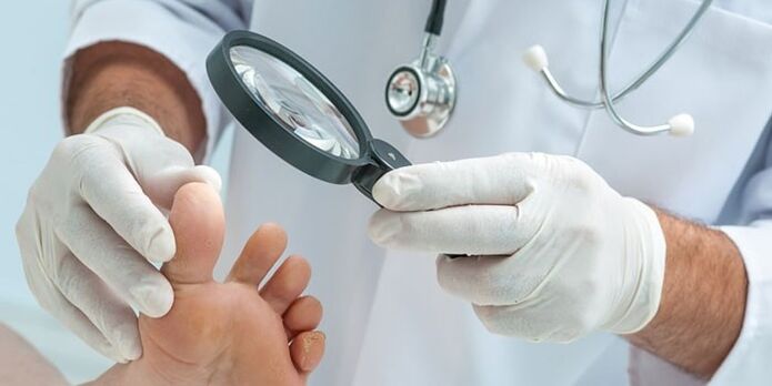 The doctor examines the foot infected with a fungus