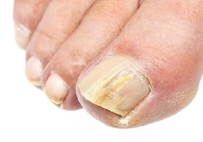 What does the nail fungus look like