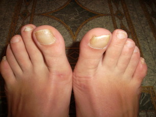 the fungus big toe but