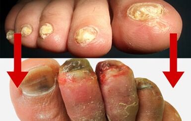 manifestations of fungi of the fingers