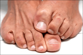 itching of the skin of the feet due to a fungal infection of the nails
