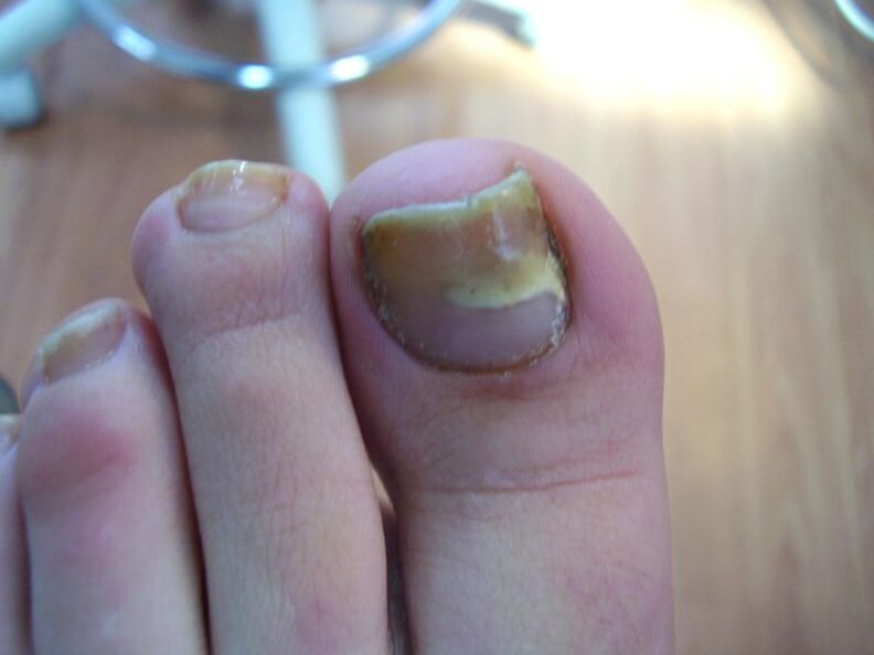 How to treat yellow nails from fungus with drops