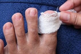 Compress for nail fungus
