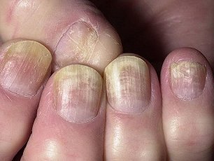 fungal nails