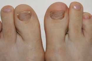 Symptoms of fungal foot