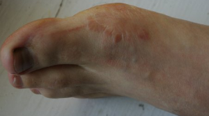 the first stage of the fungus on your feet